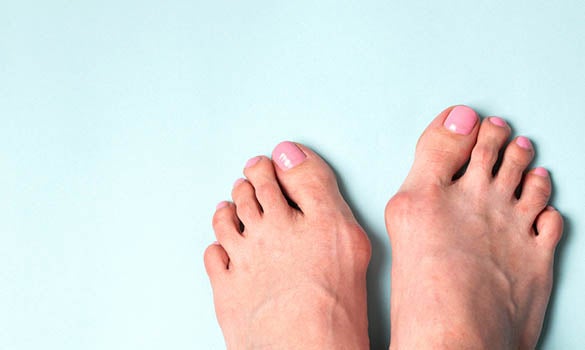 The Advent of Minimally Invasive Bunion Surgery - SKH