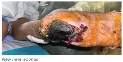 New heel wounds - SingHealth Duke-NUS Vascular Centre