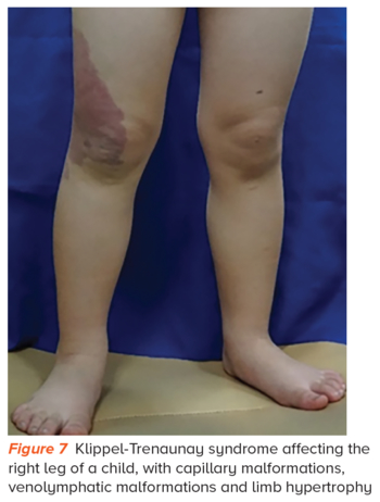 Klippel-Trenaunay syndrome - SingHealth Duke-NUS Vascular Centre