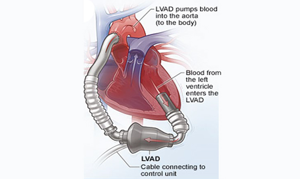 are an excellent option for patients with an advanced heart failure.