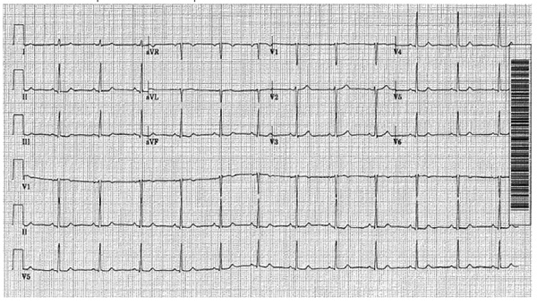 ECG Correct Lead Connections