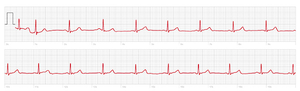 Sample ECG Sinus Rhythm