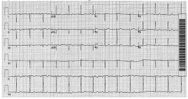 ECG Limb Lead Reversal