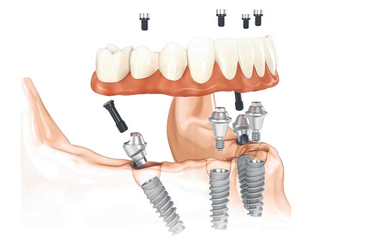  ​procedure tilts two of the implants to ensure a secure base for the full denture. 