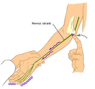 Cubital Tunnel Syndrome