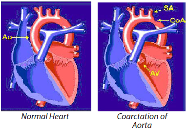 normal heart vs. coarctation of aorta | SingHealth