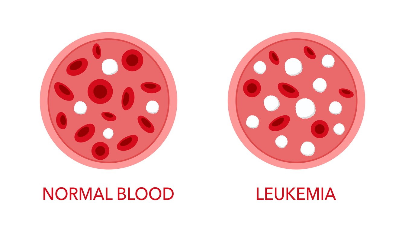 Comparison of normal blood and leukemia
