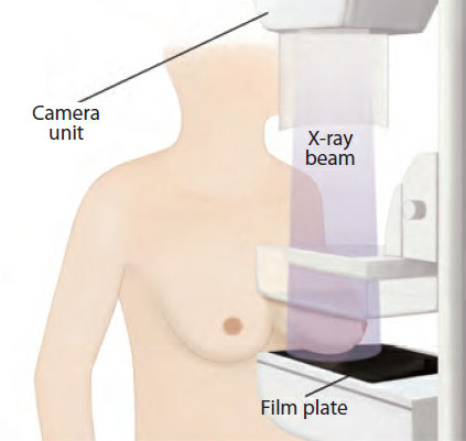 mammogram screening