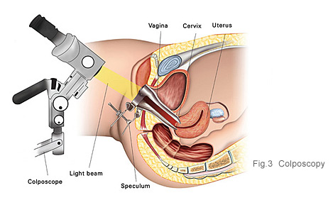 diagnosis of cervical cancer