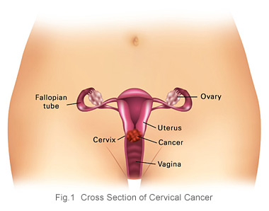cross section of cervical cancer