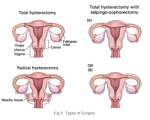 types of surgery for cervical cancer