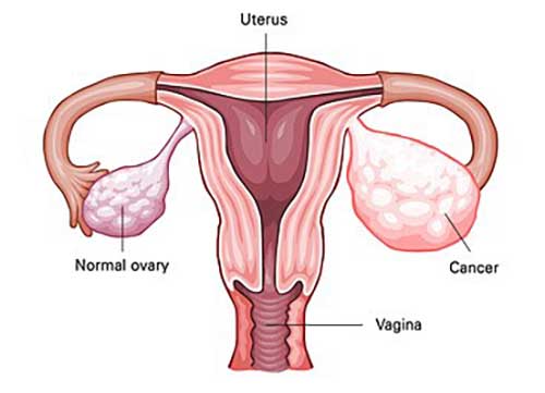 a comparison between a healthy ovary and one with ovarian cancer