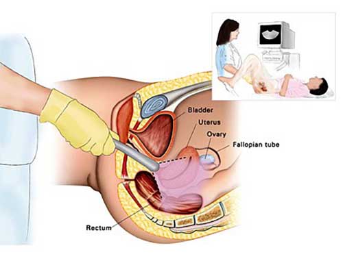 ultrasound scan to diagnose ovarian cancer