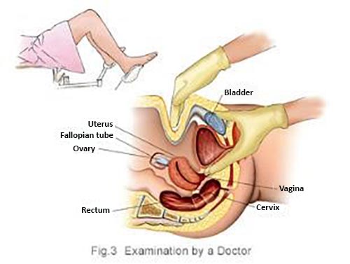 pelvic examination to diagnose ovarian cancer