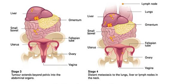 surgery option for ovarian cancer