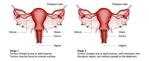 surgery for ovarian cance