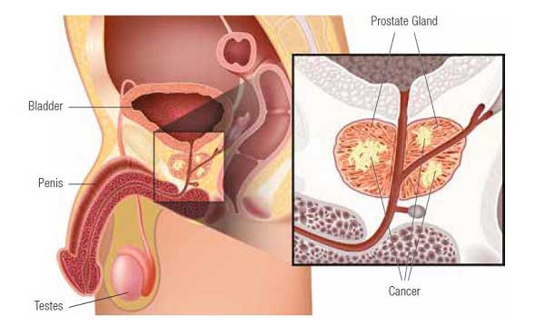 prostate cancer conditions & treatments