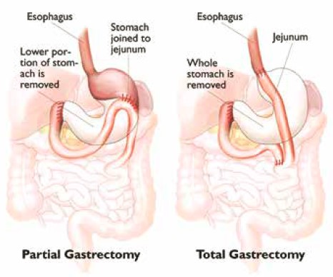 Partial or total gastrectomy to treat stomach cancer | SingHealth