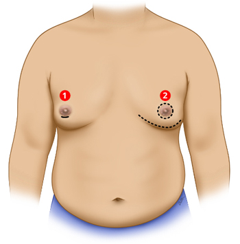 Gynaecomastia surgery - Conditions and Treatments