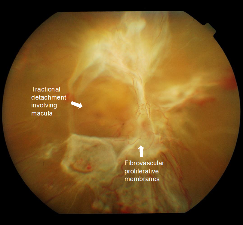 diabetic retinopathy that causes retinal detachment