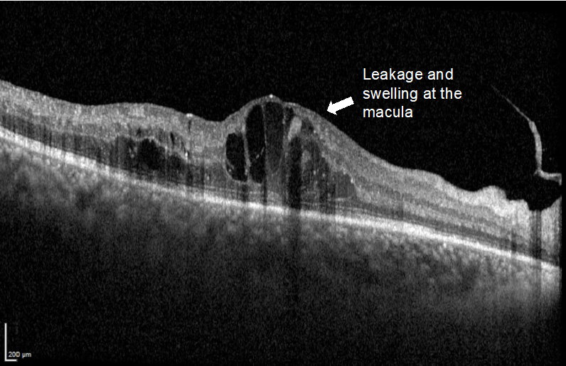 diabetic macular edema for diabetic retinopathy