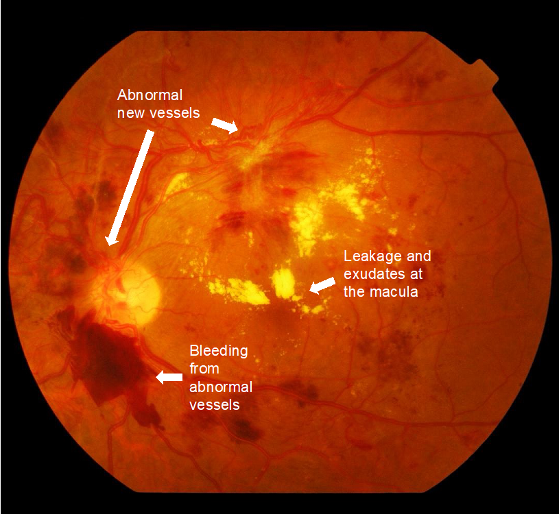 diabetic retinopathy with abnormal blood vessels in retina