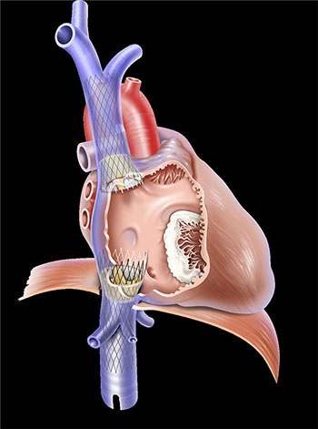 TricValve bioprosthetic valves implanted