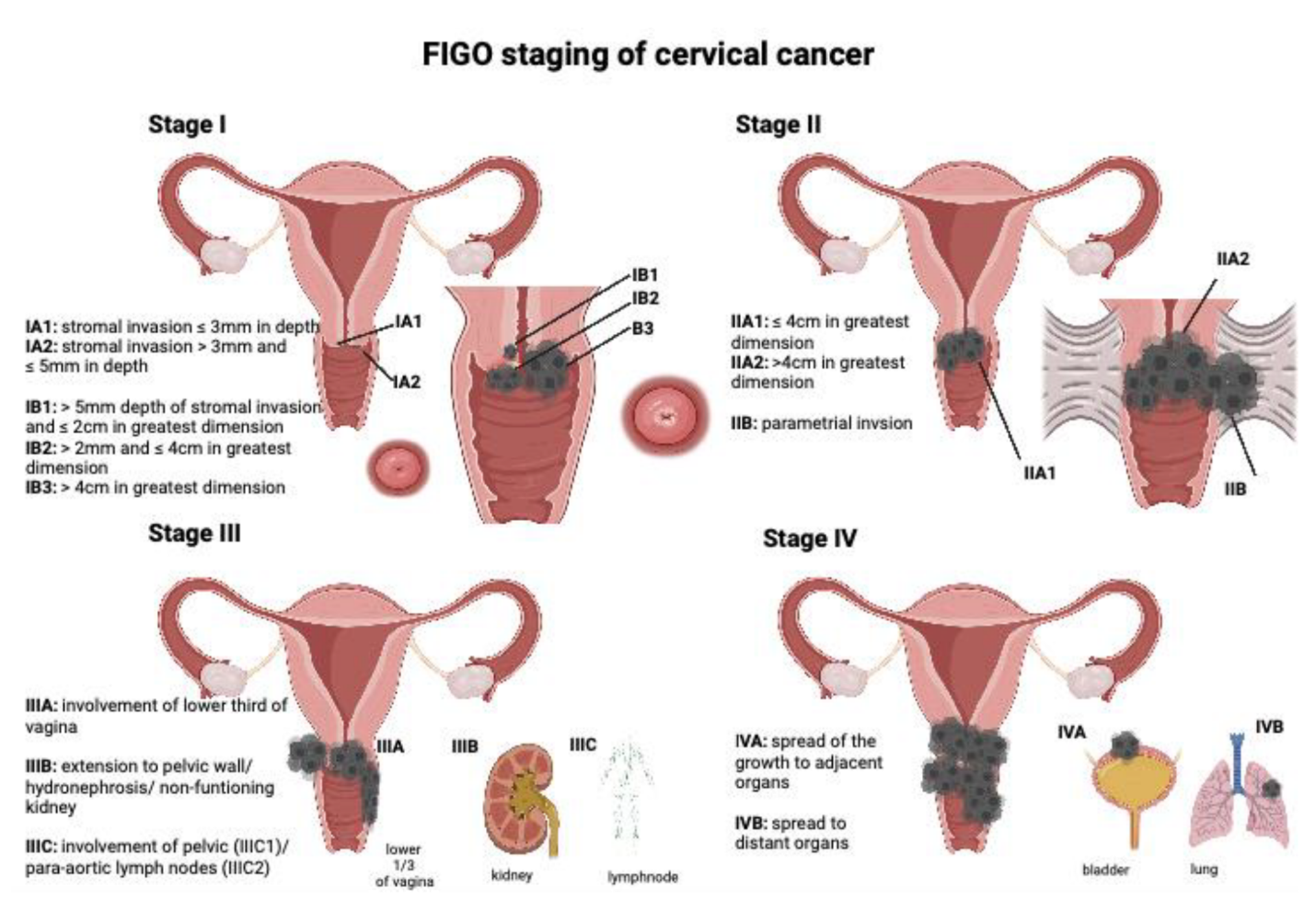 Cervival cancer staging | SingHealth