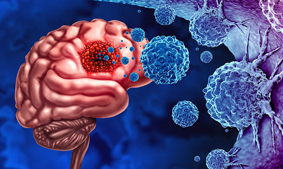 Glioma tumour in the brain | SingHealth