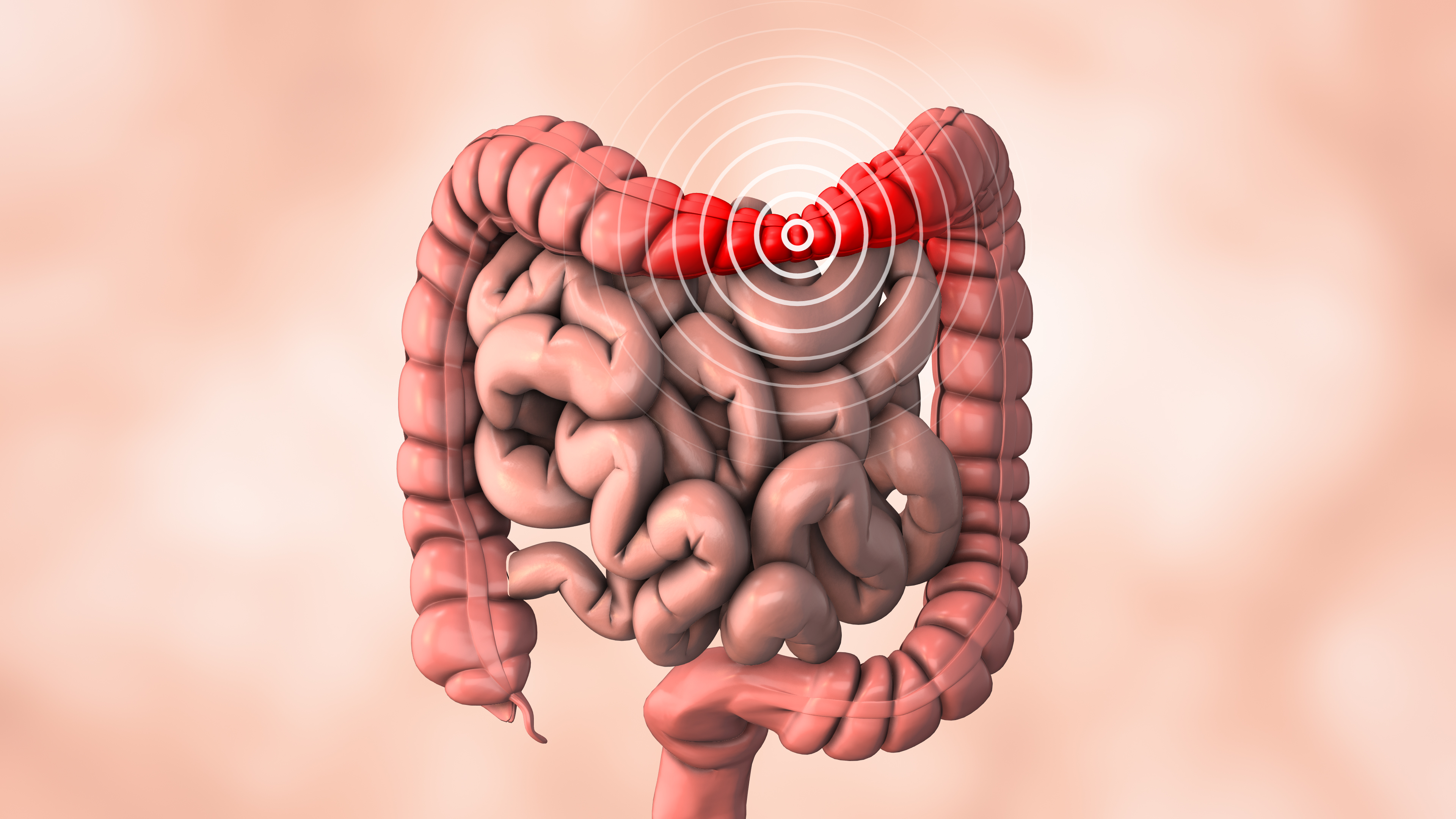 Irritable bowel syndrome (IB) is a chronic gastrointestinal disorder | SingHealth