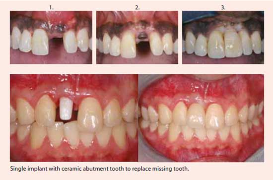 Restorative treatment at National Dental Centre Singapore