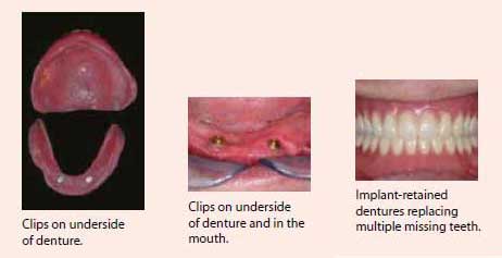 Dentures procedures at National Dental Centre Singapore