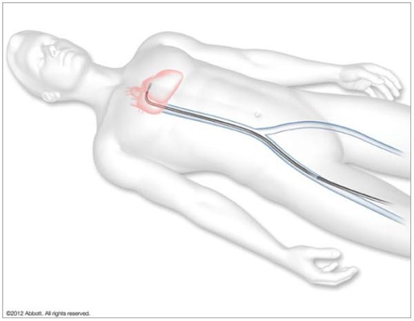 mitraclip device attaching to mitral valve