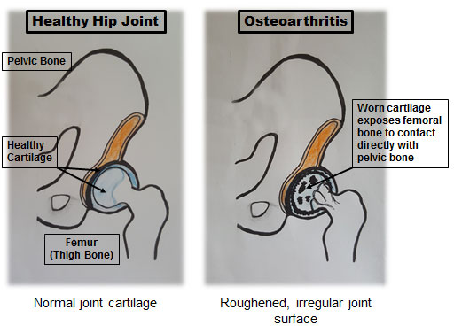 Total Hip Replacement