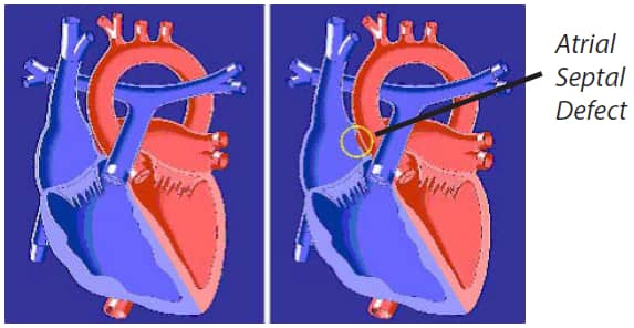 Illustration of a heart with atrial septal defect | SingHealth