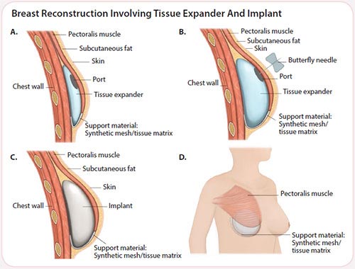breast implants surgery for breast cancer