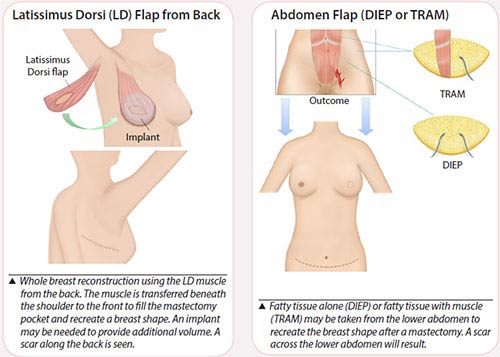 breast cancer treatment - flap reconstruction