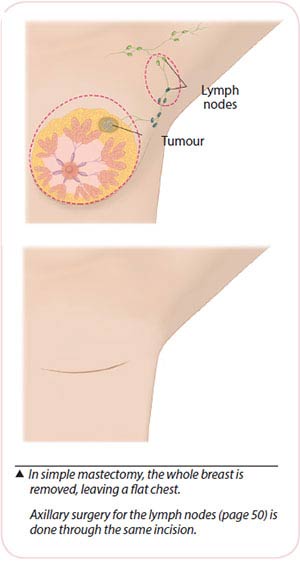 breast cancer treatment - mastectomy