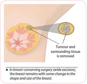 breast cancer treatment - breast-conserving surgery wide excision