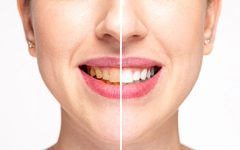 Discoloured Teeth, Teeth Stains