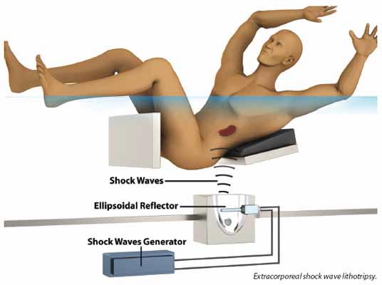 ESWL as a treatment for kidney stones 