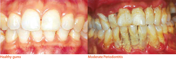 Comparison between healthy gums and periodontitis - National Dental Centre Singapore