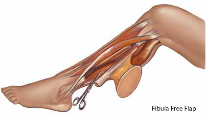 Fibula Free Flap - SingHealth Duke-NUS Head and Neck Centre