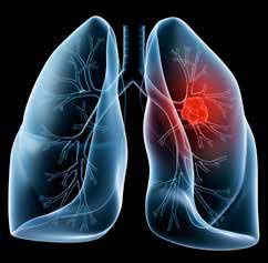 heart affected by haemoptysis | SingHealth