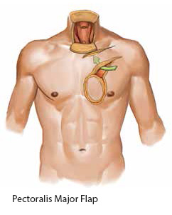 Pectoralis Major Flap - SingHealth Duke-NUS Head and Neck Centre