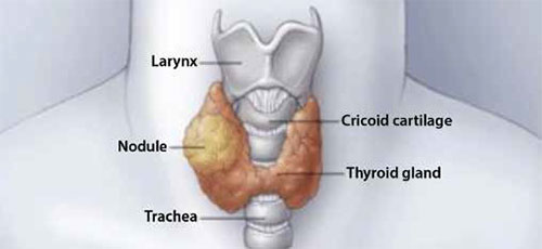 Thyroid nodules lumps may cause symptoms of hyperthyroidism according to SingHealth Duke-NUS Head and Neck Centre.