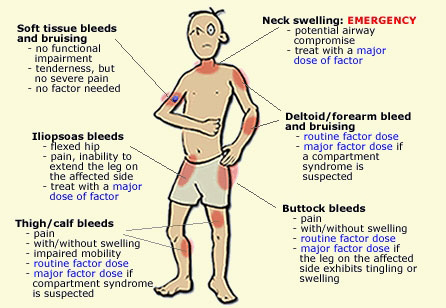 KKH shares about haemophilia.