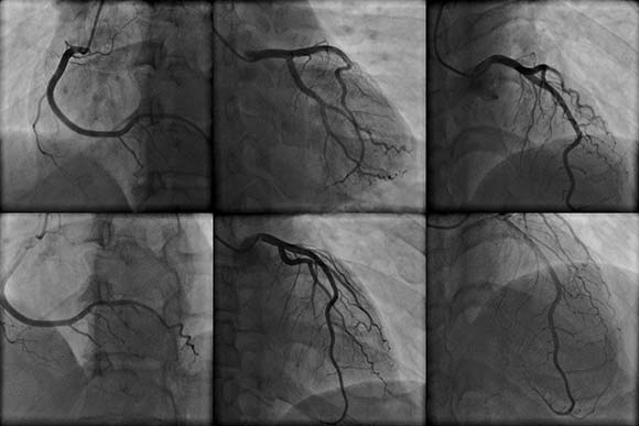 corona angiography in x-ray
