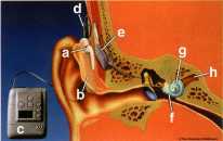 how cochlear implant works