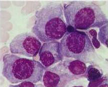 blood cells with multiple myeloma